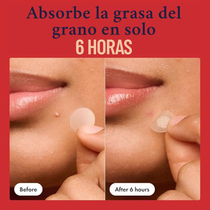 Parches Anti Acné Invisibles – Combate Brotes Mientras Duermes